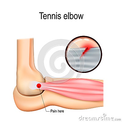 Tennis elbow or lateral epicondylitis. Vector Illustration