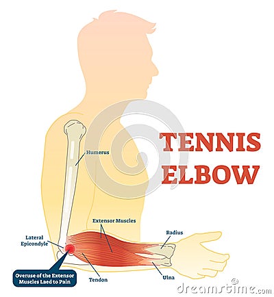 Tennis elbow medical fitness anatomy vector illustration diagram with arm bones, joint and muscles. Vector Illustration