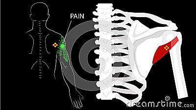 Teres minor muscle. Trigger points and referred pain in the arm and shoulder Stock Photo
