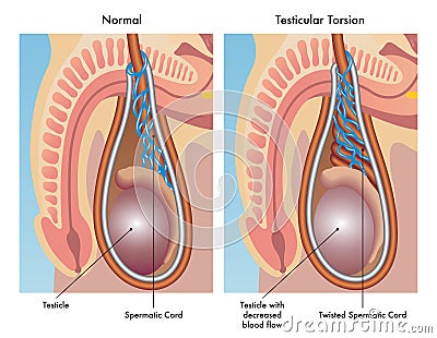 Testicular torsion Vector Illustration