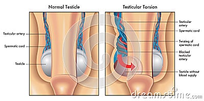 Testicular torsion Vector Illustration