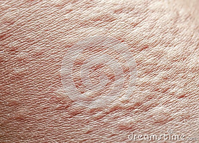 Background of the texture unhealthy irritated human skin is covered with fine wrinkles ,cracked and blistered from the burn and Stock Photo