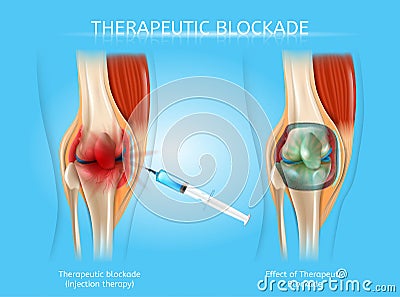 Therapeutic Blockage with Injection Therapy Vector Vector Illustration