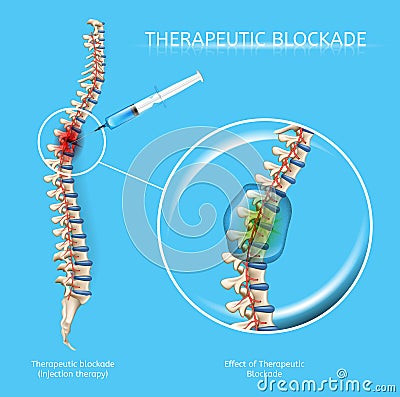 Therapeutic Blockage of Spine Diseases Vector Vector Illustration