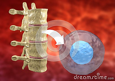 Therapy with stem cells taken from the bone marrow to treat diseases of the human body Stock Photo