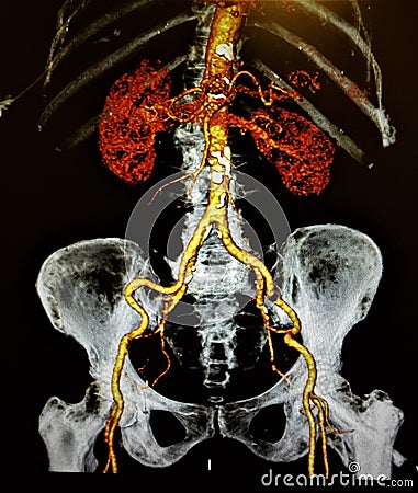 Ct angiography anterior view lumbar pelvis Stock Photo