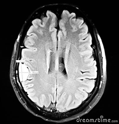 Brain extra axial convexity mass lesion mri exam Stock Photo