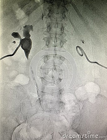 Xray nephrostomy contrast kidney position control Stock Photo