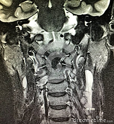Nasopharyngeal carcinoma mri head neck exam Stock Photo