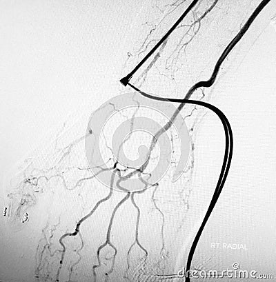 Right radial artery catheterization angiogramm ct Stock Photo