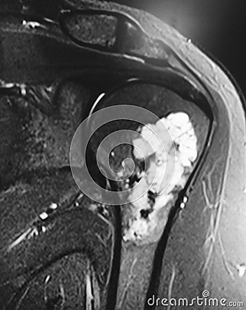 Large chondroid lesion mri examination Stock Photo