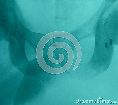 Xray examination abdomen pelvis shrapnel war victim Stock Photo