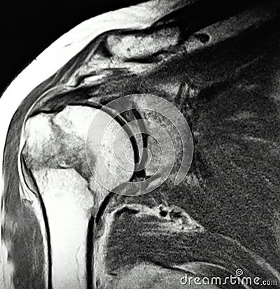 Right humeral surgical neck fracture mri exam Stock Photo