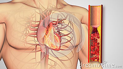 Atherosclerosis disease or Human heart with blocked arteries Stock Photo