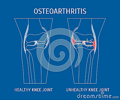 Thin Line Osteoarthritis Healthy and Unhealthy Knee. Vector Vector Illustration