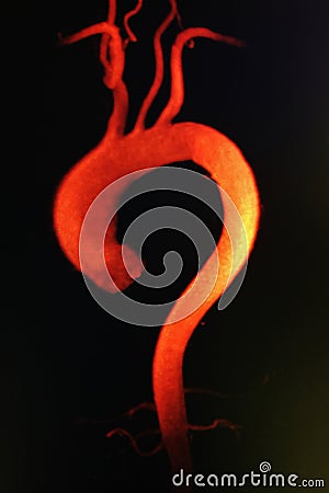 Thoracic aorta aneurism mra Stock Photo