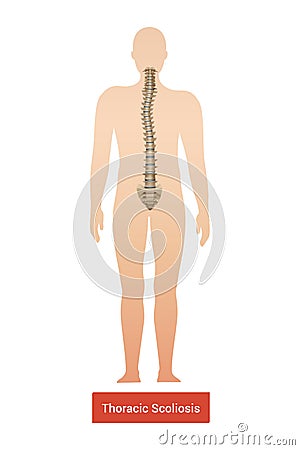 Thoracic Scoliosis Anatomic Composition Vector Illustration