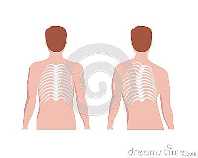 Thoracic Scoliosis on the thoracic spine and straight backbone concept vector illustration in flat design isolated on Vector Illustration