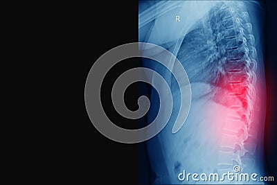 X-ray Thoracic spine fracture radiograph of thoracic and lumbar spine lateral projection, traumatology and orthopedics Stock Photo