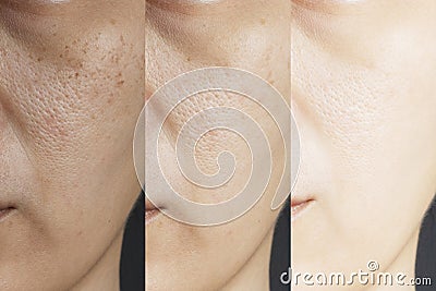 Three pictures compared effect Before and After treatment. skin with problems of freckles , pore , dull skin and wrinkles Stock Photo