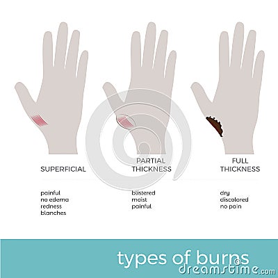 Three types of skin burns Vector Illustration