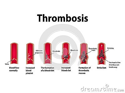 Thrombocytosis. Embolism. Infographics. Vector illustration on isolated background Vector Illustration