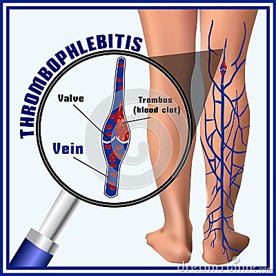Thrombophlebitis, blood clots in the veins. Embolism. Thrombosis Vector Illustration