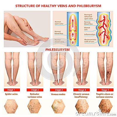 Thrombophlebitis. Deep Vein Thrombosis. Varicose veins Stock Photo