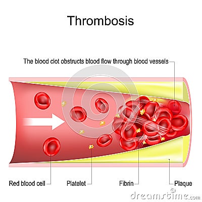 Thrombosis. The blood clot obstructs blood flow through blood vessels Vector Illustration