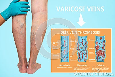 Thrombosis. From Normal blood flow to Blood clot formation Stock Photo