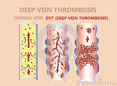 Thrombosis. From Normal blood flow to Blood clot formation Cartoon Illustration