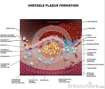 Thrombus, blood clot, unstable plaque Vector Illustration