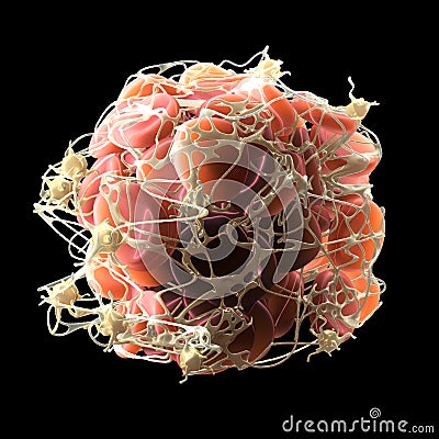 Thrombus in bloodstream, blood clot with activated platelets and fibrin, medically 3D illustration Cartoon Illustration