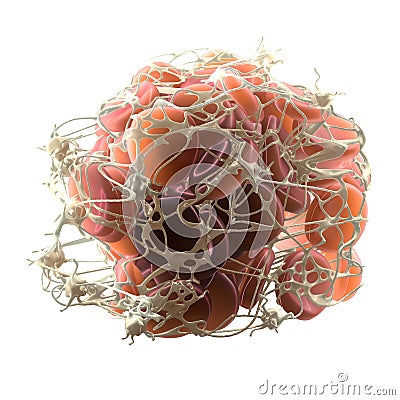 Thrombus in bloodstream, blood clot with activated platelets and fibrin, medically 3D illustration Cartoon Illustration