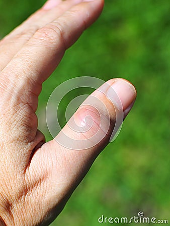 Thumb finger joint get sudden, intense pain in a night like gout Stock Photo