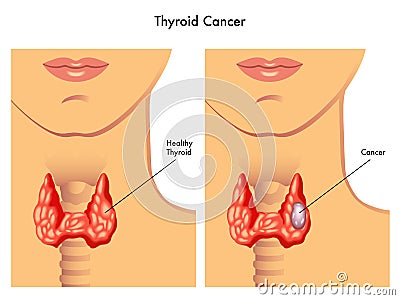 Thyroid cancer Vector Illustration