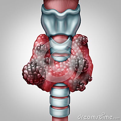 Thyroid Cancer Concept Cartoon Illustration