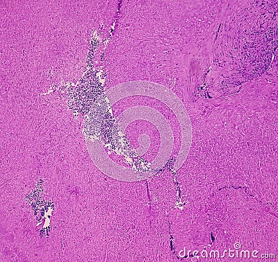 Thyroid cancer: Microscopic image of Follicular neoplasm. Malignant neoplasm of atypical thyroid follicular epithelial cells. Stock Photo