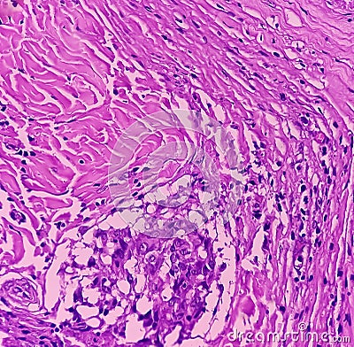 Thyroid cancer: Malignant neoplasm of atypical thyroid follicular epithelial cells. Stock Photo