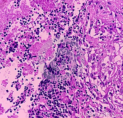 Thyroid cancer: Microscopic image of Follicular neoplasm. Malignant neoplasm of atypical thyroid follicular epithelial cells. Stock Photo