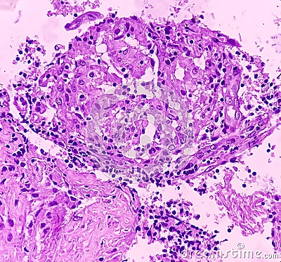 Thyroid cancer: Microscopic image of Follicular neoplasm. Malignant neoplasm of atypical thyroid follicular epithelial cells. Stock Photo