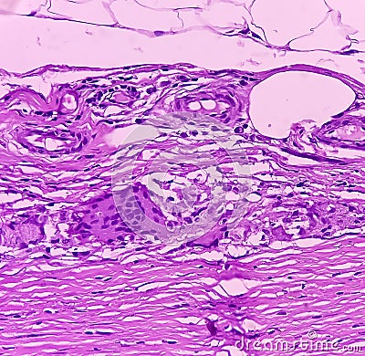 Thyroid cancer: Microscopic image of Follicular neoplasm. Malignant neoplasm of atypical thyroid follicular epithelial cells. Stock Photo