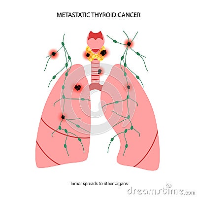 Thyroid cancer stages Vector Illustration