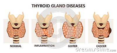 Thyroid gland diseases Vector Illustration