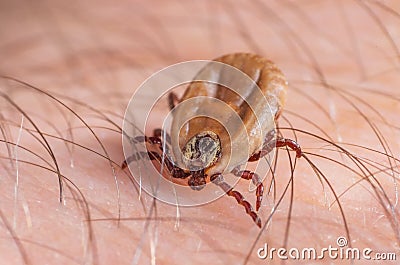 Tick filled with blood sitting on human skin Stock Photo