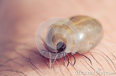 Tick filled with blood sitting on human skin Stock Photo