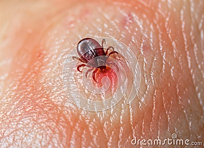 tick on skin with erythema migrans - lyme disease symptoms Stock Photo