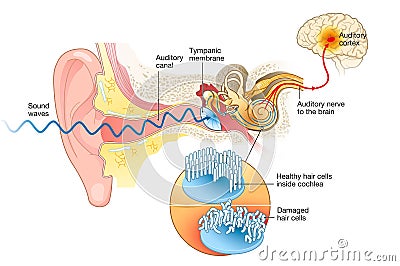 Tinnitus. Damaged hair cells inside cochlea Stock Photo