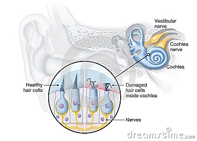Tinnitus, healthy and damaged hair cells inside cochlea, medical illustration Stock Photo