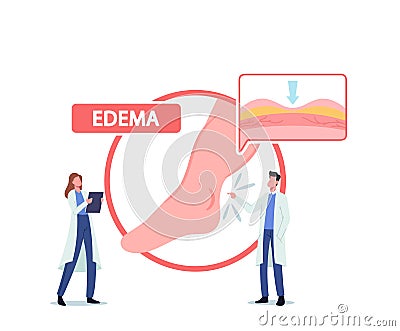 Tiny Doctor Characters Presenting Huge Infographics with Patient Diseased Legs, Medical Concept of Edema, Lymphedema Vector Illustration